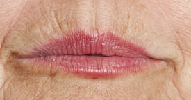 Injections de Botox Rides de la lèvre supérieure Genève, Rolle, Nyon